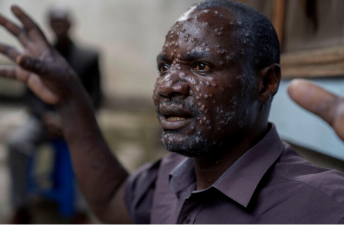 Mpox : une épidémie négligée en Afrique qui pourrait devenir la prochaine pandémie