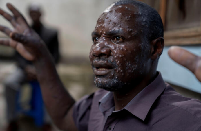 Jean Kakuru Biyambo, 48 ans, atteint du mpox, à l’hôpital de Goma, en République démocratique du Congo, le 16 juillet 2024. ARLETTE BASHIZI/REUTERS